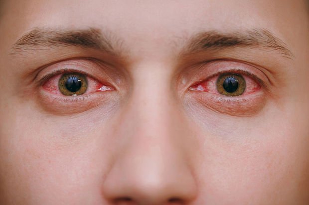 Qripə yoluxanların DİQQƏTİNƏ: 1686160478 red eye.jpg